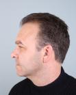 Before Hair Transplant&nbsp;Temporal Hairline